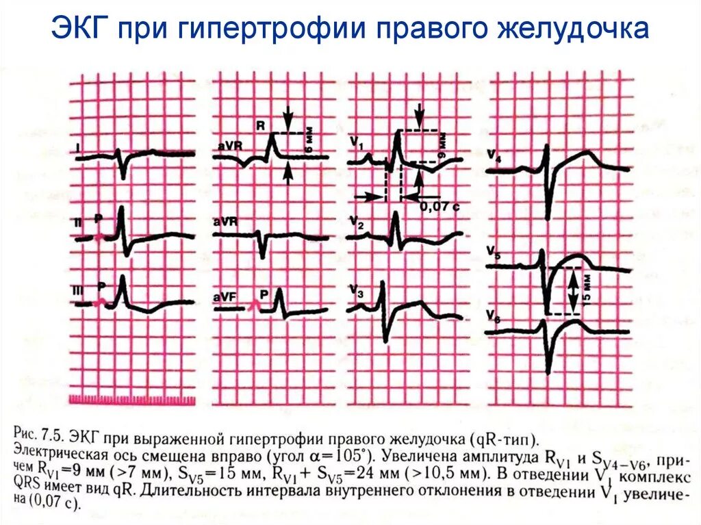 Гипертрофия правого желудочка на ЭКГ. ЭКГ при гипертрофии правого желудочка. Гипертрофия правого желудочка сердца на ЭКГ. Признаки гипертрофии правого желудочка сердца на ЭКГ. Экг преобладание левого желудочка