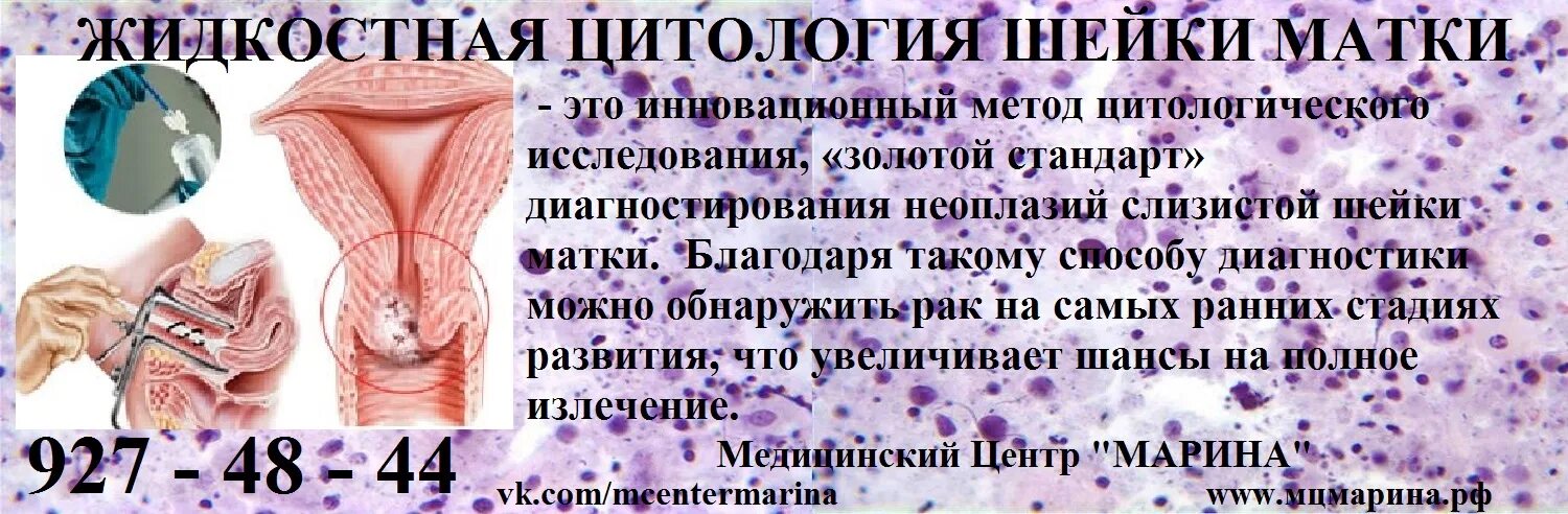 Что такое жидкостная цитология шейки матки. Жидкостная цитология шейки матки. Жидкостная цитология шейка матки. Метод жидкостной цитологии. Цитологическое исследование шейки матки норма.