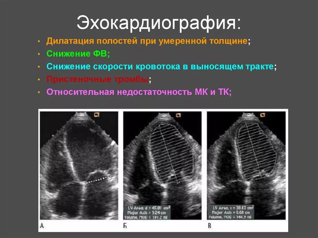 ЭХОКГ при гипертрофической кардиомиопатии. ЭХОКГ при дилатационной кардиомиопатии. Эхо кг дилатационной кардиомиопатии. Дилатация полостей предсердий