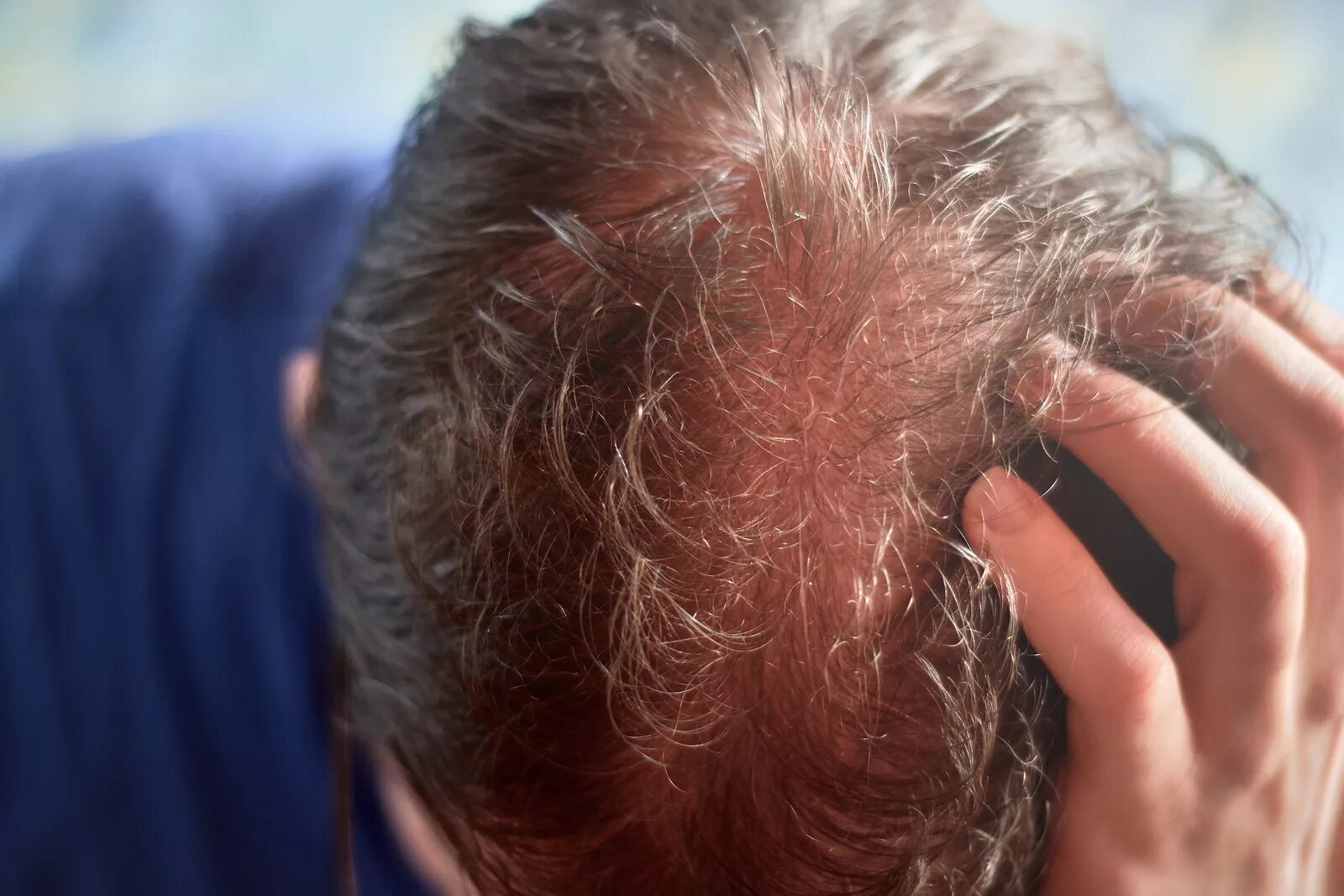 Фолликулит, гипертрихоз. Вши 2023. Вши 2023. Платяная вошь (pediculus humanus corporis). Вши 2023.