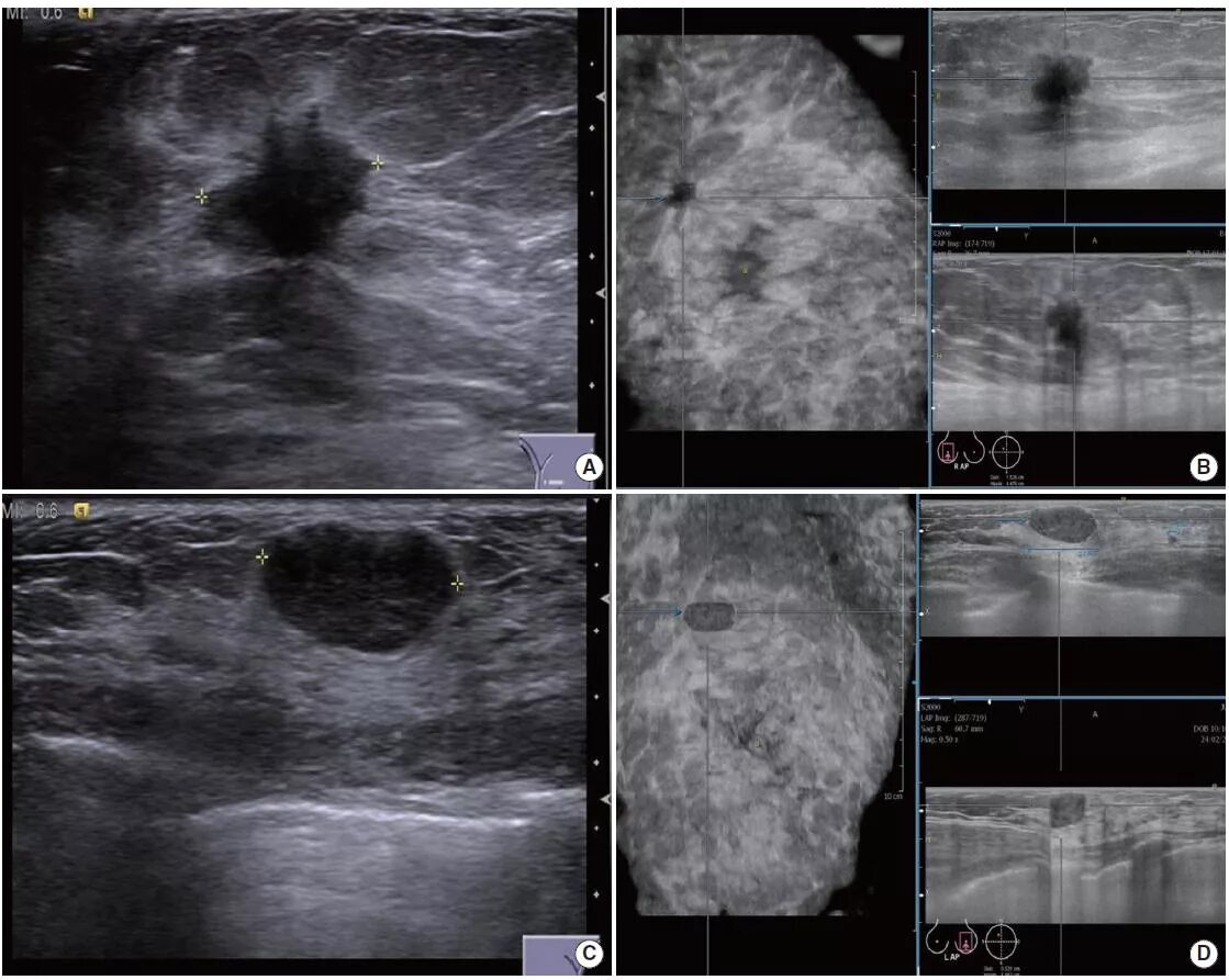 Узловая мастопатия молочной железы на УЗИ. Фибролипома маммография. Фиброаденома молочной железы на УЗИ. Карцинома грудной железы УЗИ. Rads r