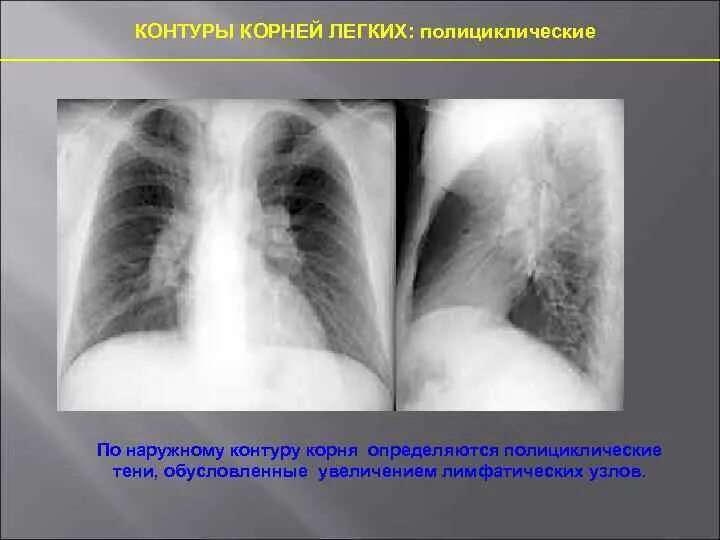 Полициклический контур корня легкого. Полициклический контур корня на рентгенограмме.