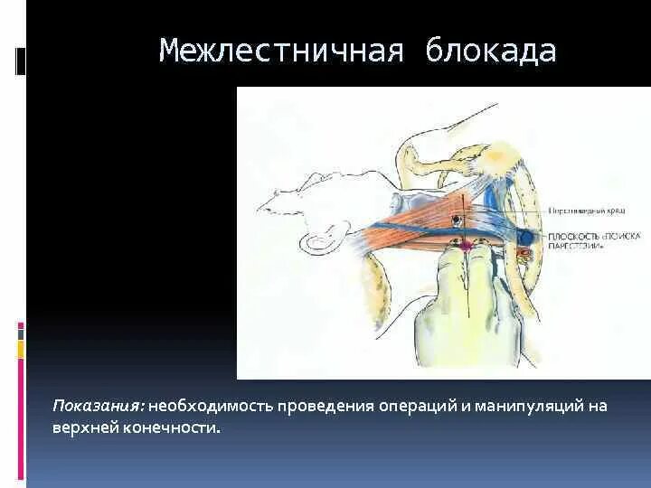 Блокада сплетения. Межлестничная анестезия. Межлестничная блокада плечевого. Блокада плечевого сплетения межлестничным доступом. Межлестничная блокада плечевого сплетения техника.