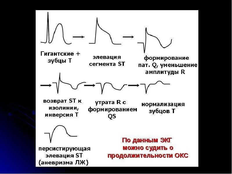 Экг подъем. Подъем сегмента St на ЭКГ v3. ЭКГ инфаркт миокарда с подъемом St. Элевация сегмента St при инфаркте миокарда. Инфаркт миокарда без подъема сегмента St.