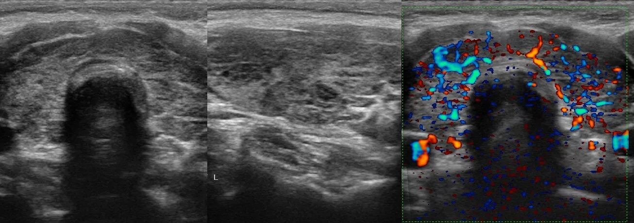 Хронический тиреоидит УЗИ картина. Тиреоидит щитовидной железы УЗИ картина. АИТ на УЗИ щитовидной железы. Подострый тиреоидит щитовидной железы УЗИ картина. Щитовидная железа изменения на узи
