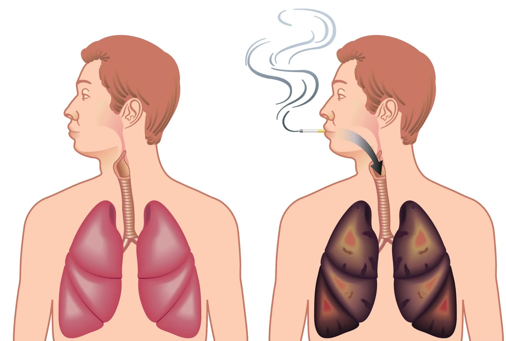 В сердце раны в легких никотин. Легочно дыхательная система курильщика. Лёгкие курщего и не курящего. Легкие курильщика и здорового человека.
