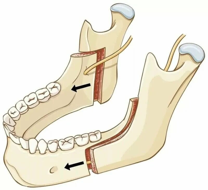 Межкортикальная остеотомия нижней челюсти. Остеотомия нижней челюсти операция. Полная гребня