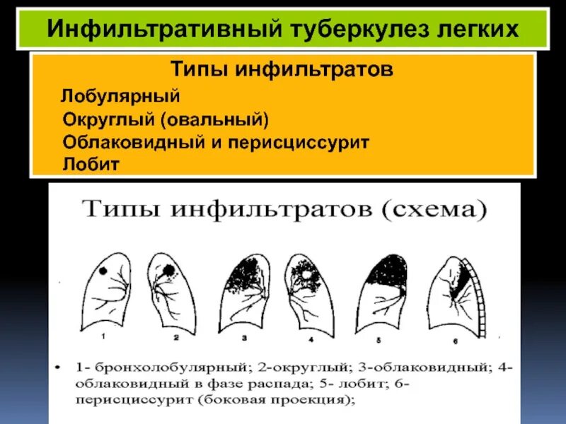 Лобить. Инфильтративный туберкулез схема. Перисциссурит инфильтративный туберкулез легких. Инфильтративный инфильтративный туберкулез. Инфильтративный туберкулез типы инфильтратов.