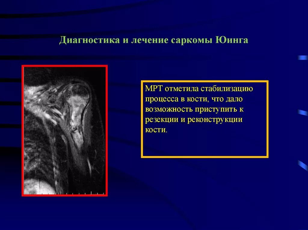 Диагноз саркома. Опухоли костей презентация.