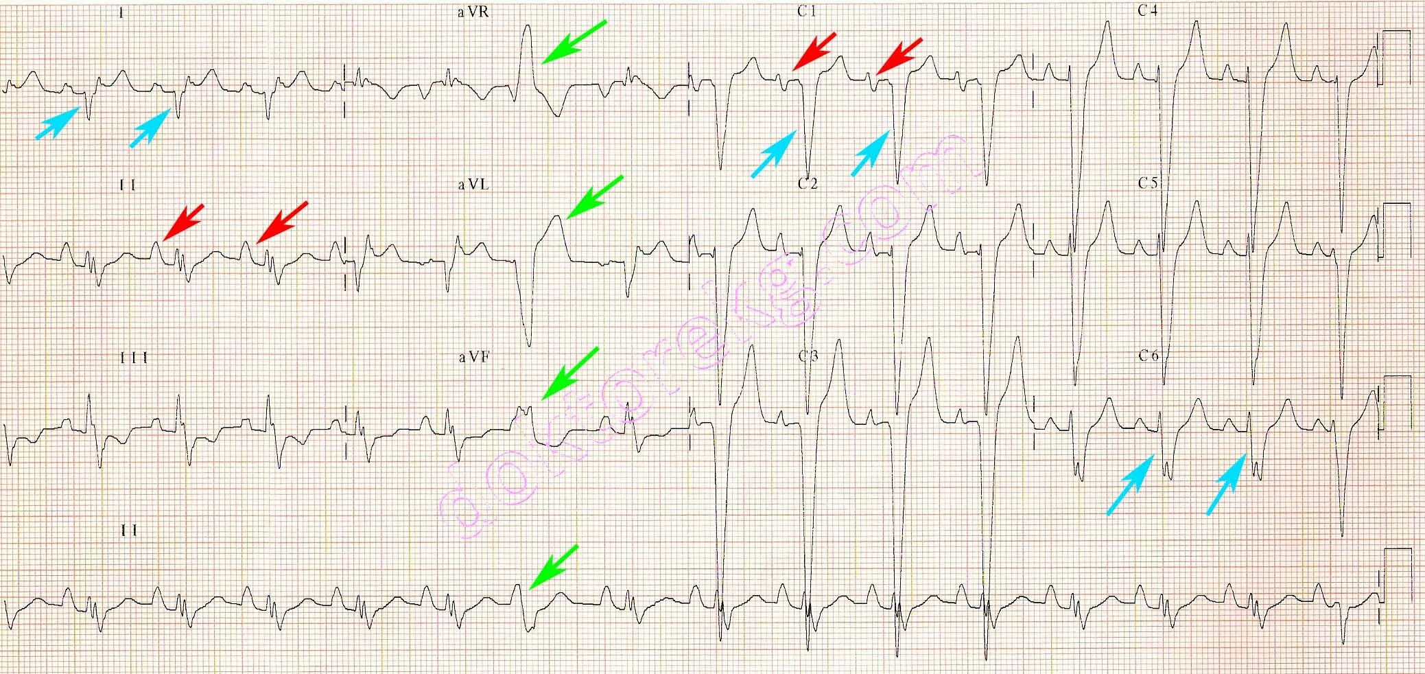 здоровая кардиограмма рисунок. плохая кардиограмма. кардиограмма при неврозе. кардиограмма сердца. лента экг 25 мм 50 мм.