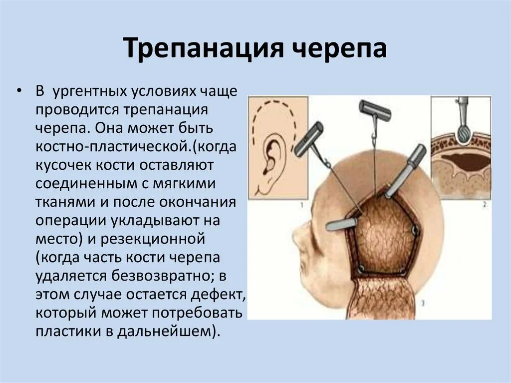 Костно-пластическая Трепанация черепа осложнения. Однолоскутная Трепанация черепа. Костнопластическая Трепанация черепа показания. Костно-пластическая Трепанация черепа по Оливекрону.