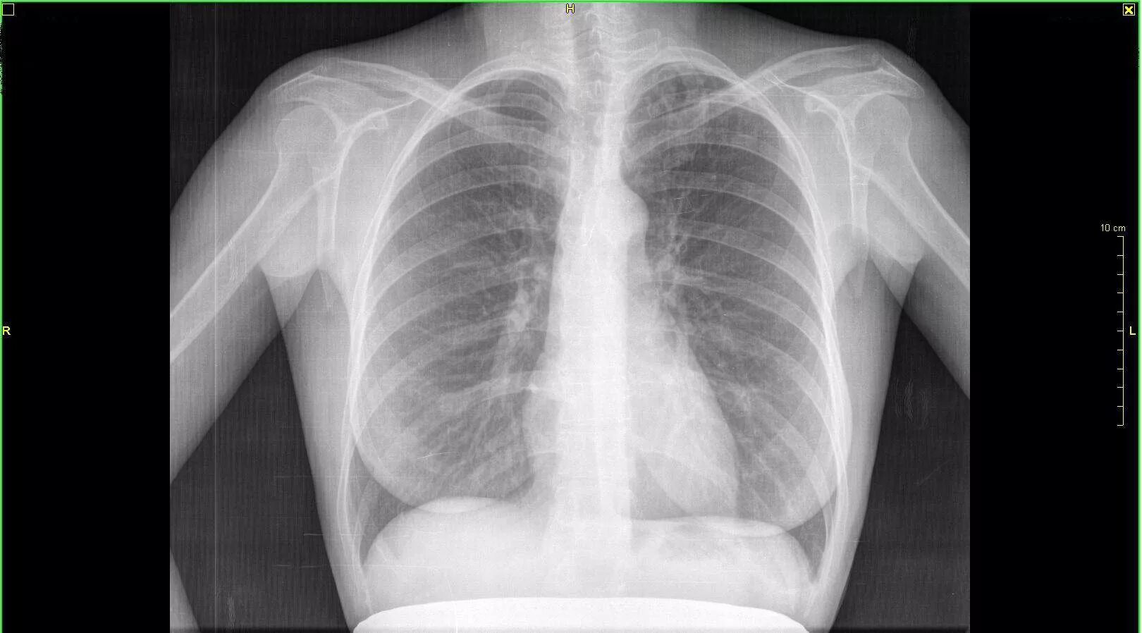 Флюорография легких. Рентген легких здорового человека. Рентген лёгких здорового человека. Рентген снимок лёгких здорового человека. Флюорография грудной клетки норма.