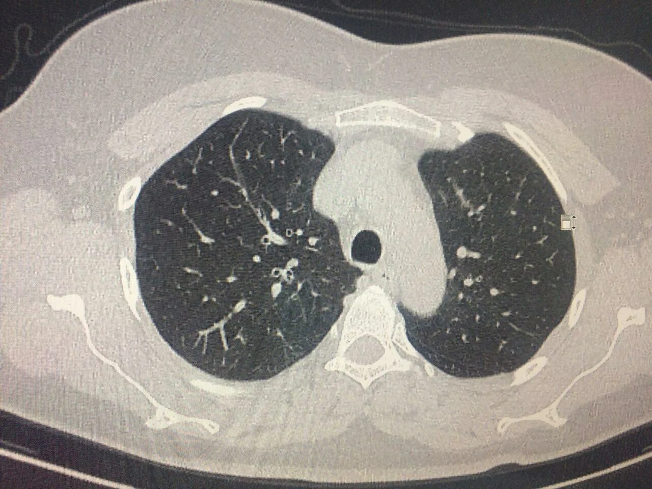 Что такое ркт. РКТ ОГК. РКТ органов грудной клетки. Рентгеновская кт. Рентгеновская томография ОГК.