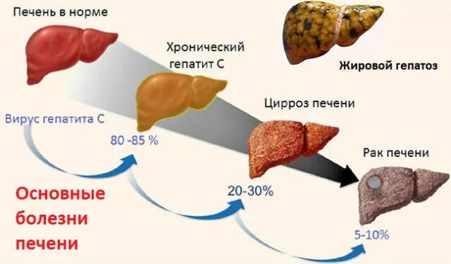 Может ли уменьшиться печень. Жировой гепатоз – жировая болезнь печени. Печень пораженная гепатитом. Печень больная гепатитом.