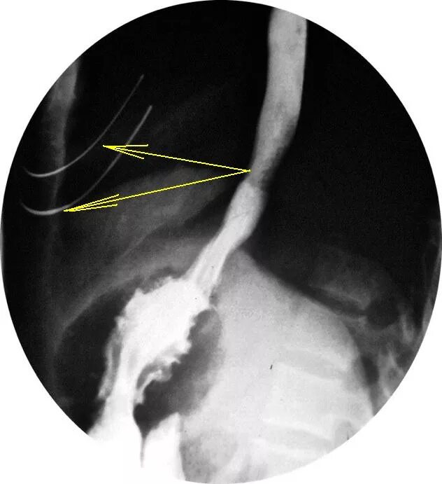 Рентгеноскопия пищевода подготовка. Фундопликация пищевода рентген. Фундопликация желудка рентген. Вздутие желудка рентген. Фундопликации по Ниссену рентген.