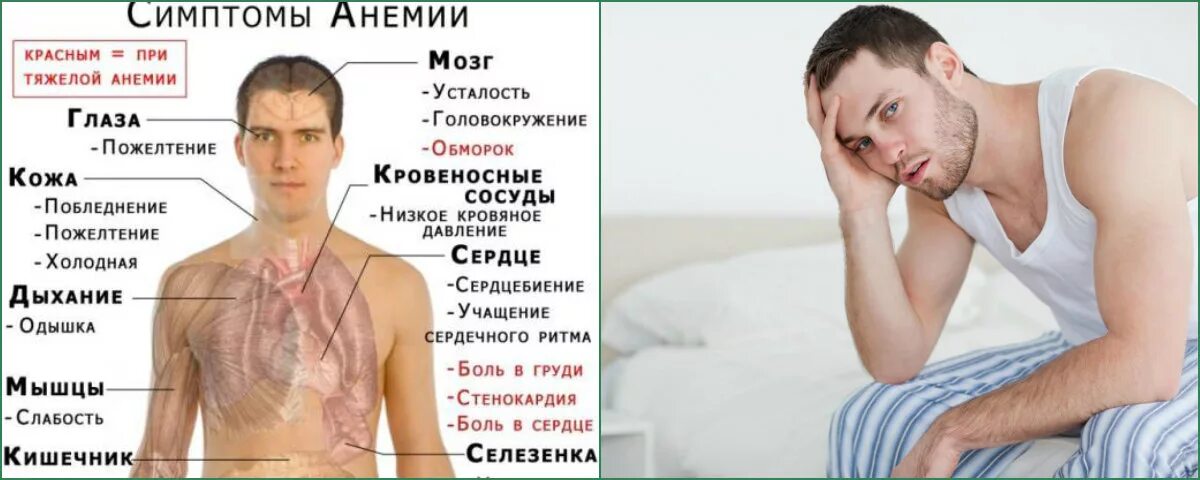 Низкими какие признаки. Симптомы болезни малокровие. Дефицит железа у мужчин. Дефицит железа симптомы у мужчин.
