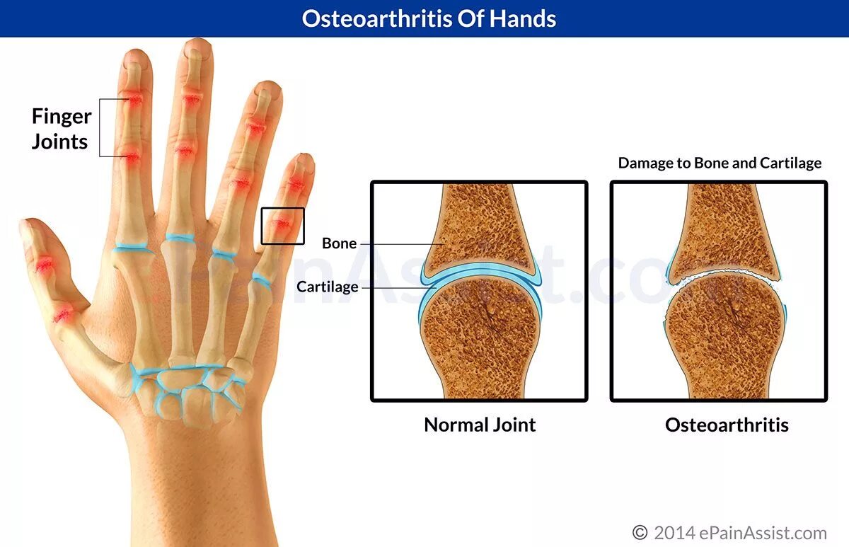 Артрит межфалангового сустава пальца. Артроз межфаланговых суставов. Остеоартроз полиостеоартроз. Ревматоидный артрит запястного сустава.