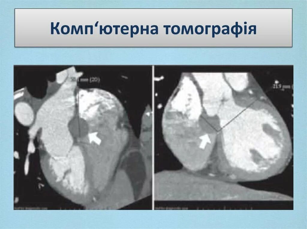 Образование левого предсердия. Миксома межпредсердной перегородки. Опухоль сердца миксома. Миксома левого предсердия. Миксома левого желудочка кт.