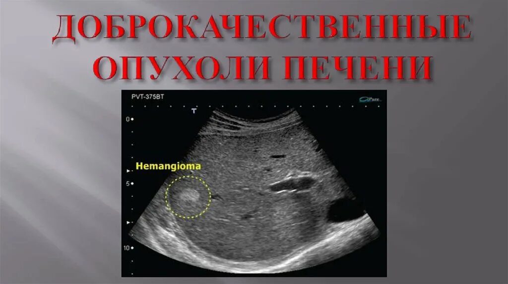 Доброкачественное образование печени. Злокачественные опухоли печени УЗИ признаки. Доброкачественные опухоли печени на УЗИ. Объемные образования печени на УЗИ.