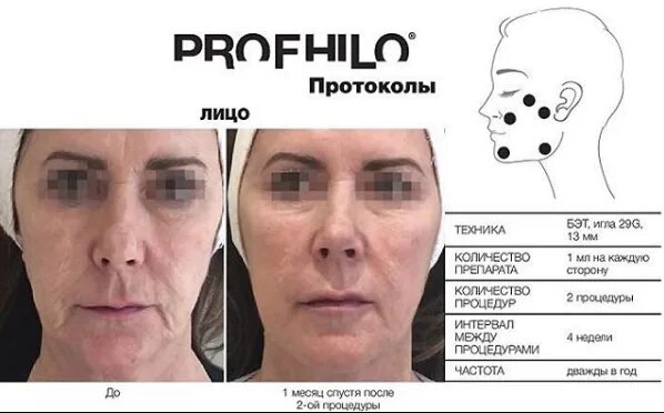 PROFHILO - ПРОФАЙЛО 2018 - Видео ВКонтакте