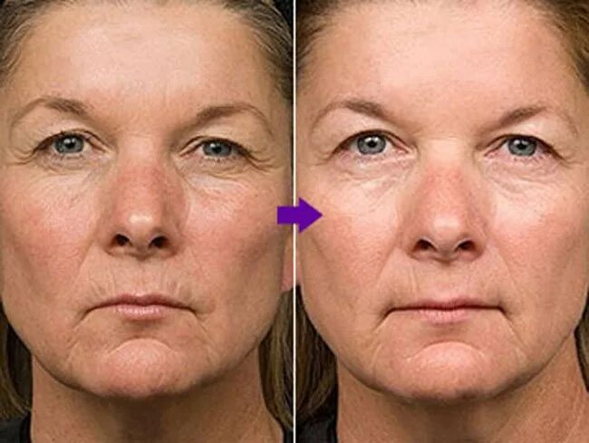 тейпы до и после. тейпирование лица до и после. тейпы для лица эффект до и после. тейпирование лица до и после. тейпы до и после лицо.