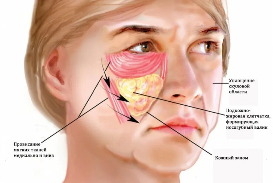 Боли костей лица. Малар ные мешки под глазами. Молярние мещки под глаз. Молярные мешки под глазами. Малярный жировой мешок.