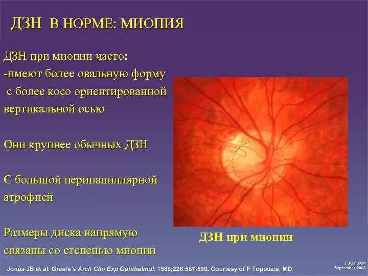 Размеры зрительных нервов. Экскавации диска зрительного нерва клиника. Деколорирован диск зрительного нерва.