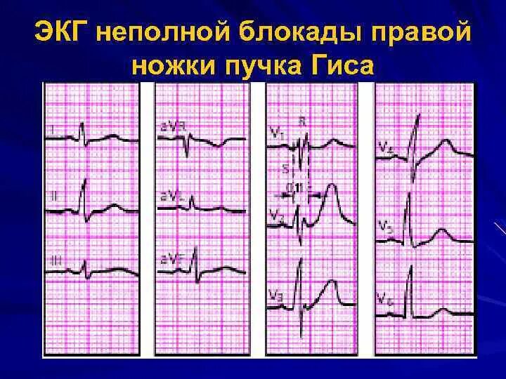 Что означает неполная блокада. Блокада ЛНПГ на ЭКГ. Полная блокада правой ножки пучка Гиса на ЭКГ. Полная блокада левой ножки пучка Гиса на ЭКГ заключение. ЭКГ фибрилляция предсердий блокада правой пучка Гиса.