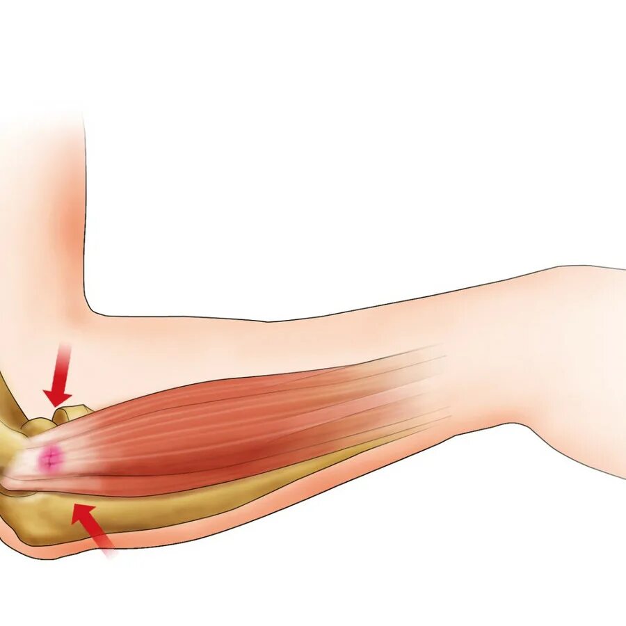 эпикондилит травматология. эпикондилит какой врач лечит. эпикондилит локтевого сустава лечебная физкультура. травма локтевого сустава эпикондилит. эпикондилит какой врач лечит.