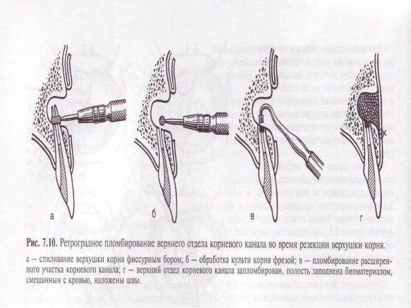 Резекция верхушки корня схема. Эмболэктомия бедренной артерии. Ретроградный корень. Ретроградный корень. Этапы ретроградного пломбирования.