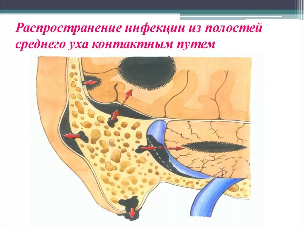 Отогенные осложнения. Преформированный путь распространения инфекции. Пути распространения инфекции воспалении среднего уха. Пути проникновения инфекции в среднее ухо. Пути распространения инфекции из среднего уха в полость черепа.