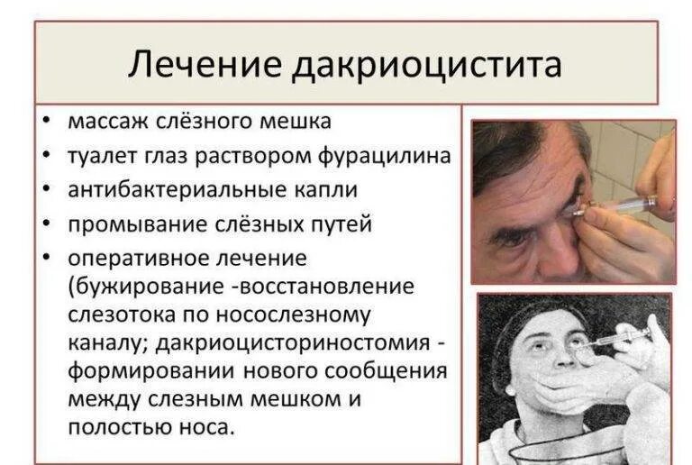 Как прочистить слезные каналы. Воспаление слезного мешка лечение. Воспаление слезного мешка у ребенка. Воспаление слезного канала у взрослых. Воспаление слезного мешка у взрослого.