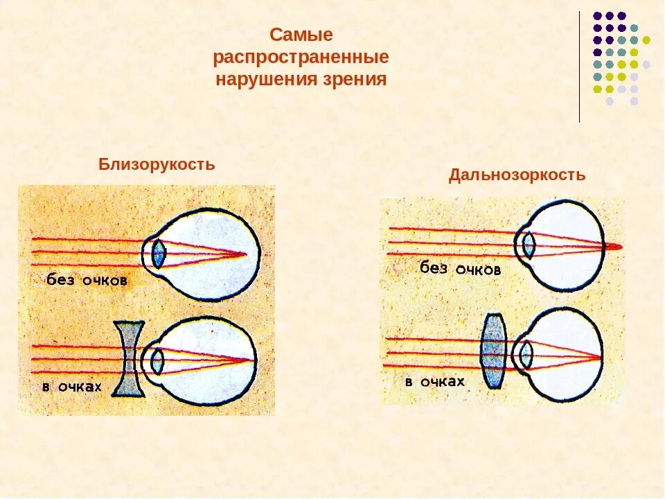 Причины нарушения зрения близорукость дальнозоркость. Нарушения зрения подростка: близорукость и дальнозоркость. Таблица заболевания глаз близорукость и дальнозоркость. Таблица нарушение зрения близорукость дальнозоркость. Миша страдает близорукостью а его брат дальнозоркостью