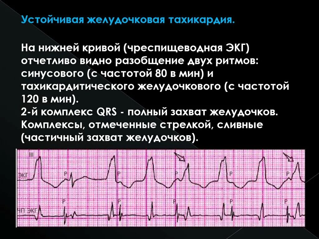 Желудочковая тахикардия на экг. Пароксизмальная желудочковая тахикардия. Тахикардия презентация. Причины желудочковой Тахи. Пароксизмальная синусовая тахикардия.