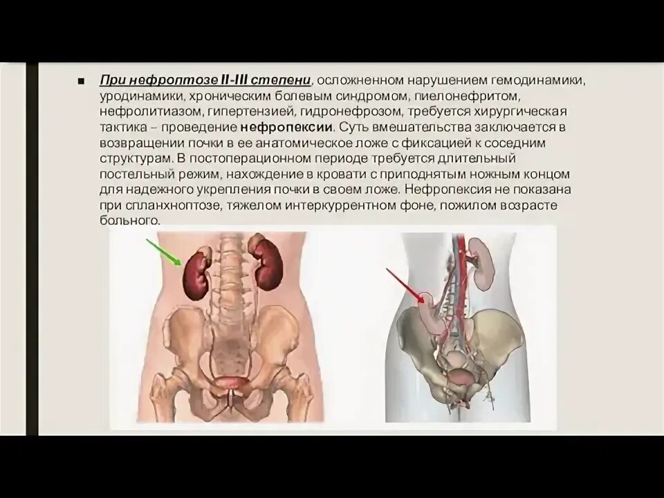 Нефроптоз почки слева. Нефроптоз почки слева