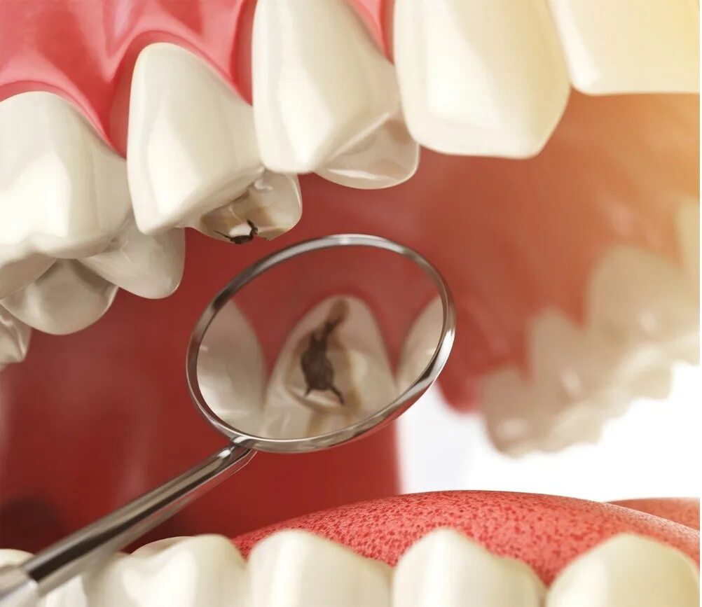 кариес сверлят зуб. зубы стоматолог. кариес сверлят зуб. кариес сверлят зуб. кариес сверлят зуб.