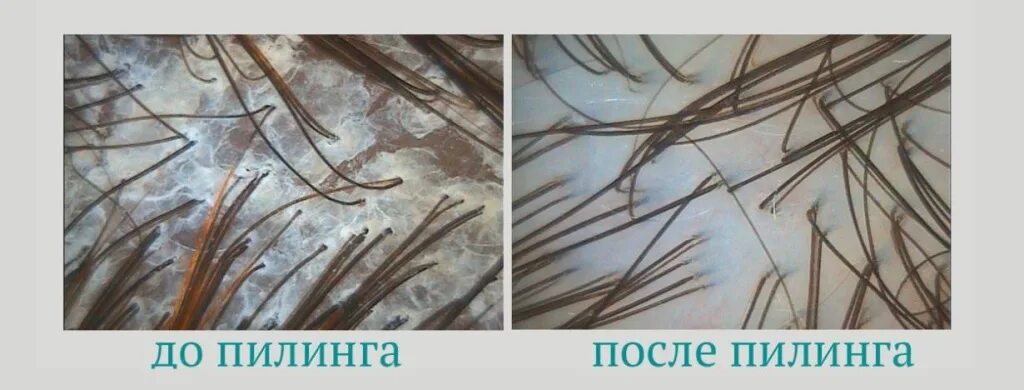 Пилинг для кожи головы и тела. Трихоскопия себорейный дерматит. себорейный дерматит под трихоскопом. пилинг кожи головы под микроскопом. кожа головы под микроскопом.
