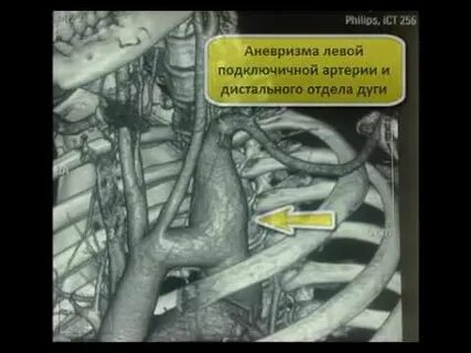 Стеноз подключичной артерии