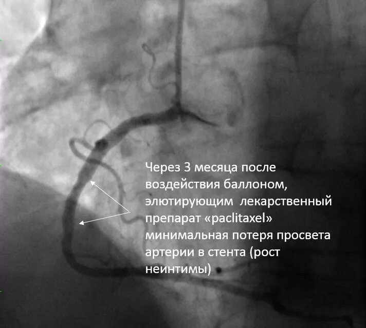 Санаторий после стентирования. Коронарография стентирование. Ангиография после стентирования. Рестеноз коронарных артерий после стентирования.