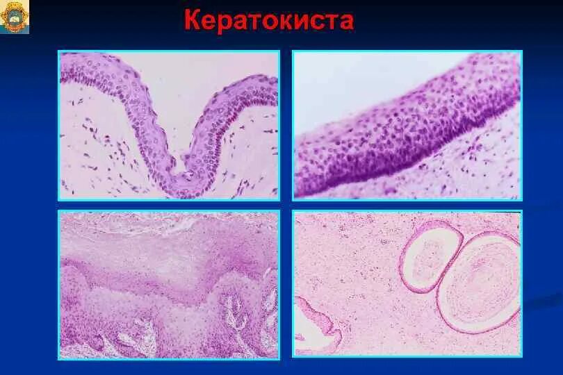 Трихоэпителиома гистология кожи. Злокачественная опухоль эпителия. Органонеспецифические эпителиальные опухоли. Опухоли из эпителиальной ткани. Опухоли эпителия.