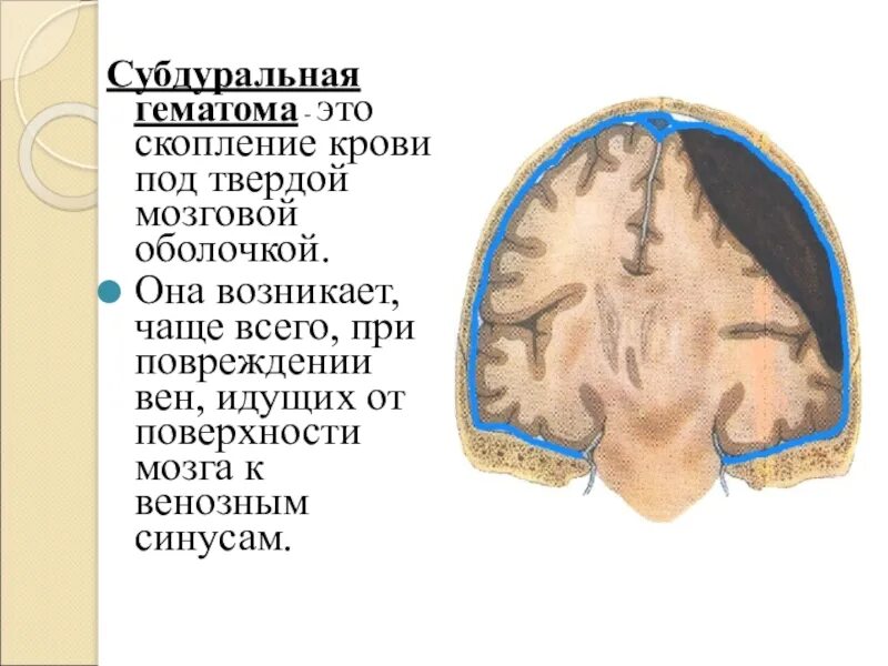 Субдуральная и эпидуральная гематома. Конвекситальная субдуральная гематома. Гематома в головном мозге. Субдуральная гематома лечение