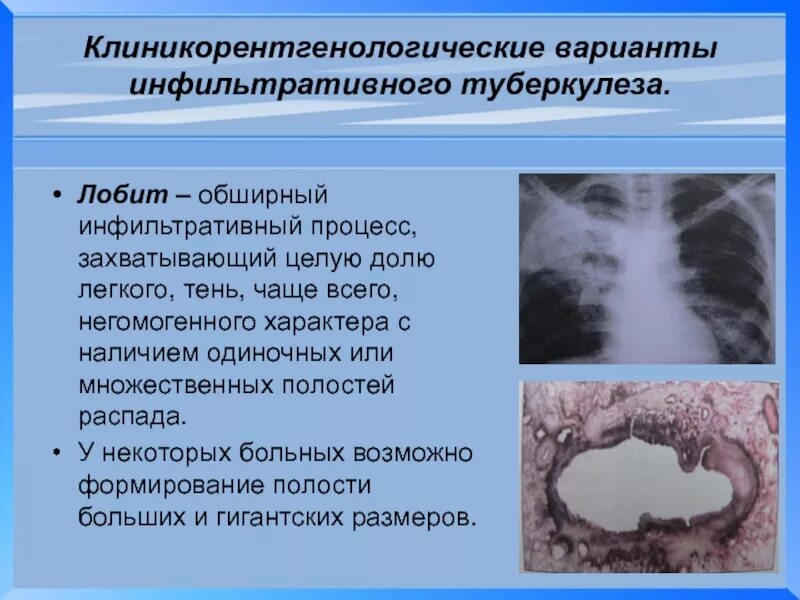 Лобить. Лобит туберкулез клиника. Инфильтративный туберкулез легких Лобит. Исходы инфильтративного туберкулеза. Лобит инфильтративный туберкулез клиника.