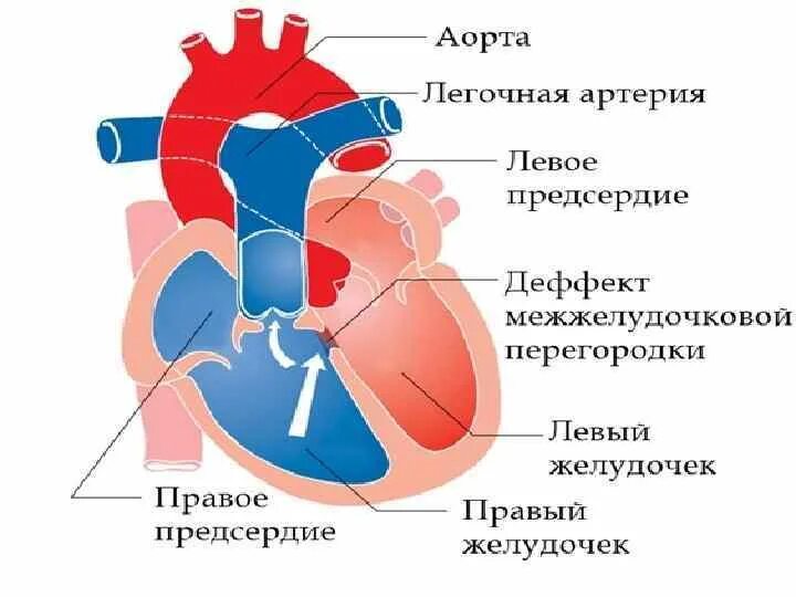 Правый желудочек и легочная артерия. Строение межжелудочковой перегородки сердца. Строение сердца легочная артерия. Строение сердца Тетрада Фалло человека.