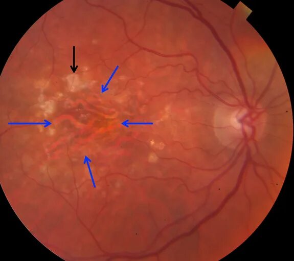 Ангиопатия сосудов мкб. Пигментный ретинит сетчатки. Ретикулярная дегенерация сетчатки. Хориоретинальный атрофический очаг.