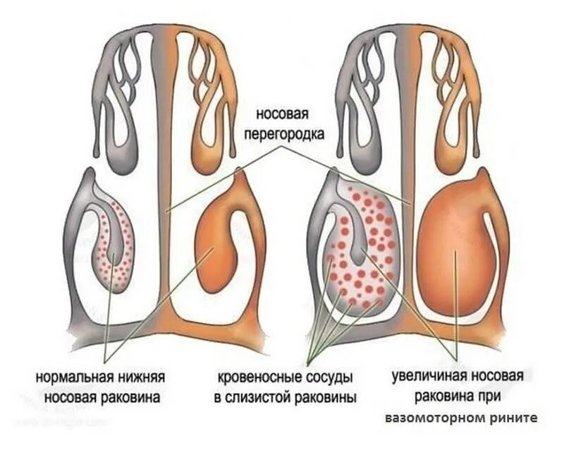 Слизистая носа вазомоторный ринит. Вазомоторный ринит цвет слизистой оболочки. Хронический вазомоторный ринит. Носовые раковины при аллергическом рините.