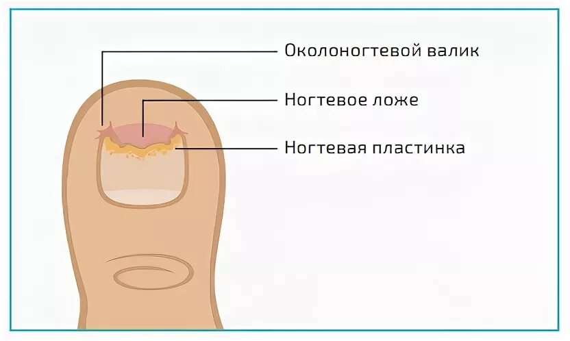 Ногтевой валик на ноге. Проксимальный подногтевой онихомикоз. Строение ногтя. Строение ногтевой пластины.