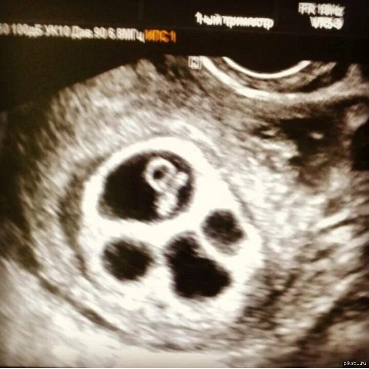 Узи 6 недель беременности двойня. Два эмбриона в одном плодном яйце. Плодное яйцо на узи 4 недели. Однояйцевая беременность двойней на узи. Эмбрион 7 недель многоплодной беременности узи.
