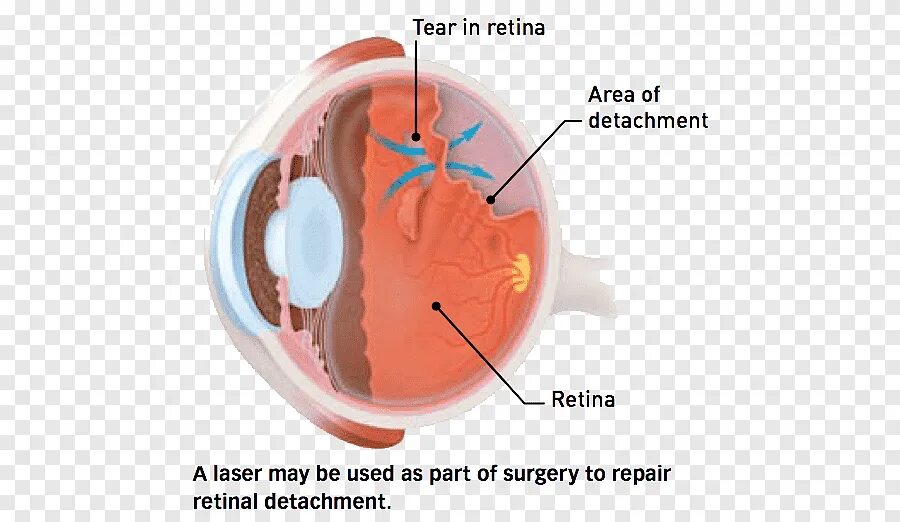 Разрыв сетчатки (retinal tear). Отслойка сетчатки глазное дно. Отслойка сетчатки витрэктомия. Жидкость в сетчатке