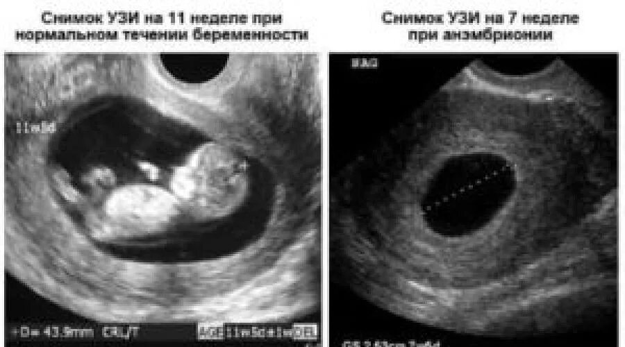 Можно ли в 6 недель. Плодное яйцо 7 недель на узи в матке. анэмбриония – замершая беременность. неразвивающаяся беременность 7 недель узи. узи анэмбриония 7 недель.