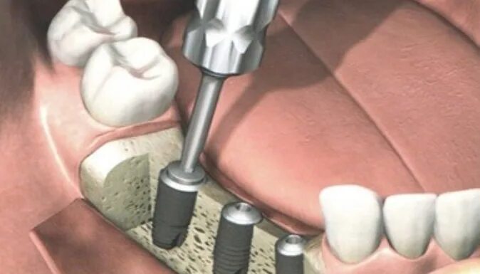 Имплант формирователь абатмент. Ms260 регулировочный винт заглушка. Заглушка на имплант. Осстем винт заглушка. Заглушка на имплант.